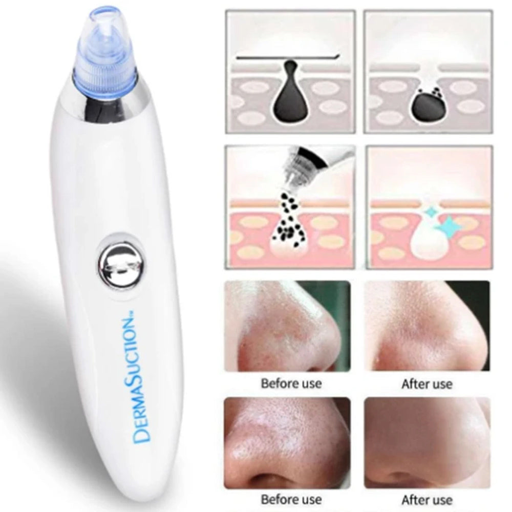 New Imported Derma Suction Blackhead Acne Oil Remover Vacuum Suction Face Pore Cleaner Facial Beauty